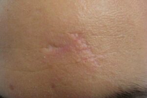 Fractional Laser αποκατάστασης ουλών