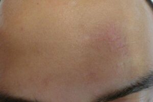 Fractional Laser αποκατάστασης ουλών